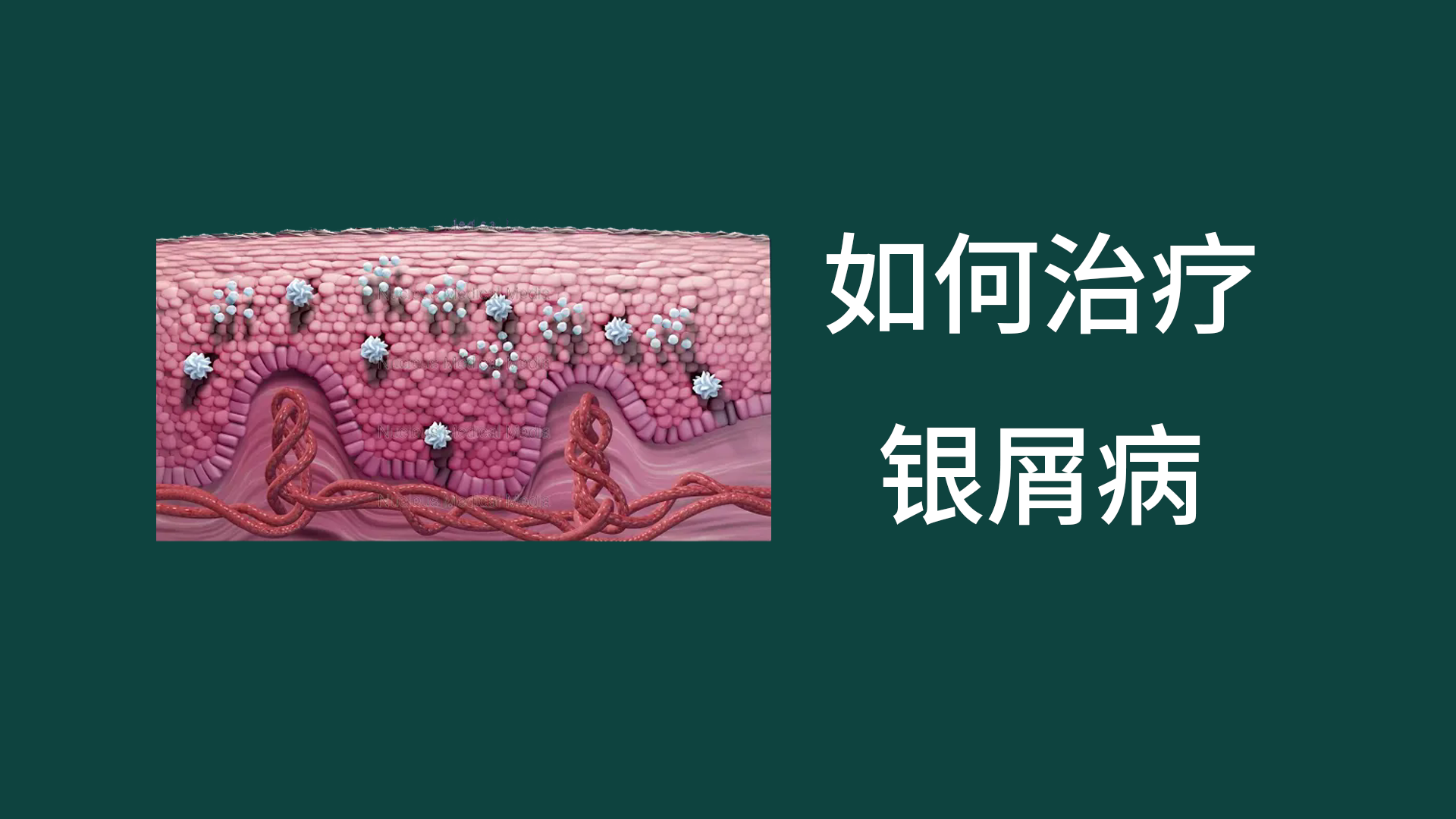 银屑病