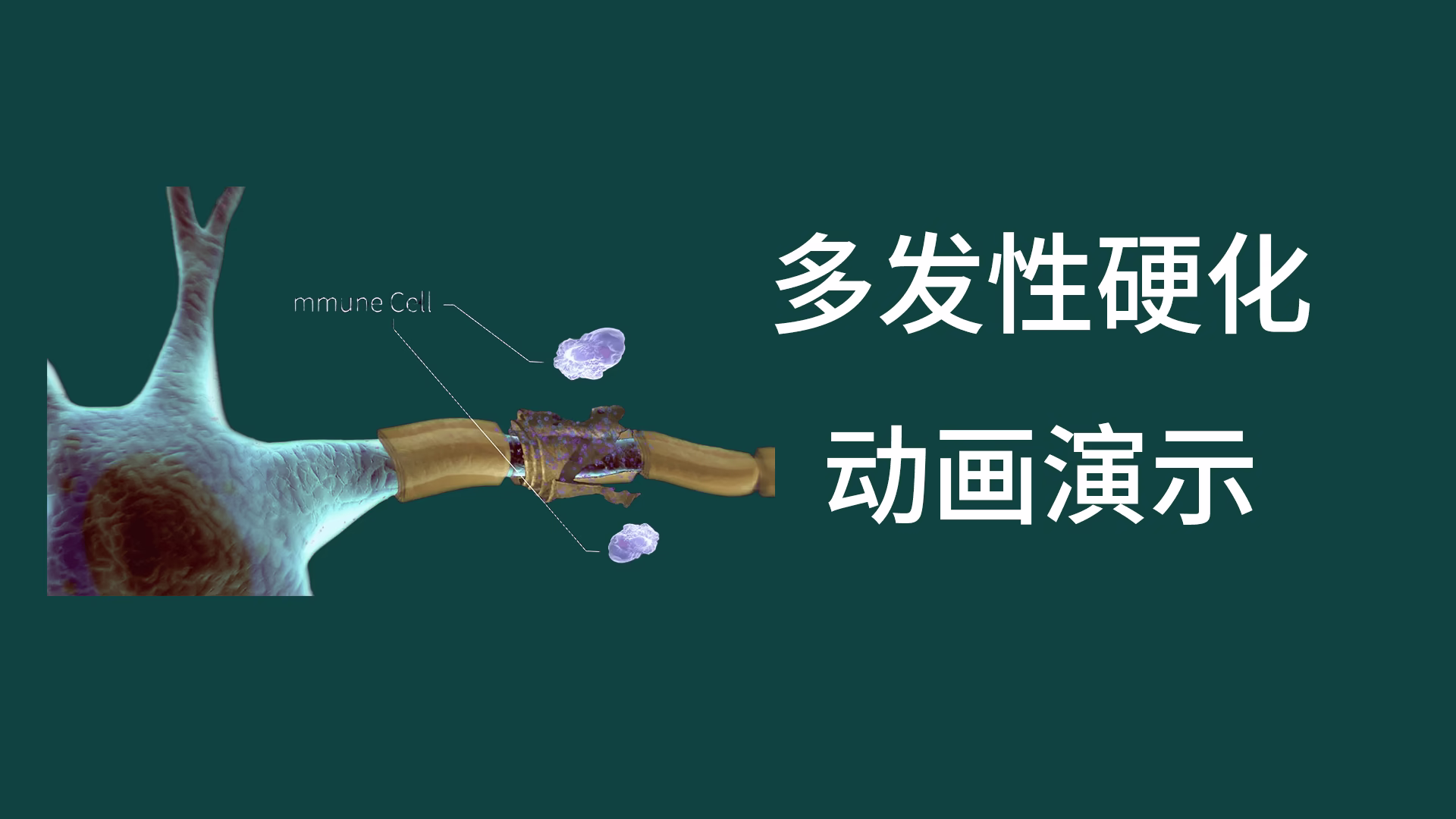 多发性硬化