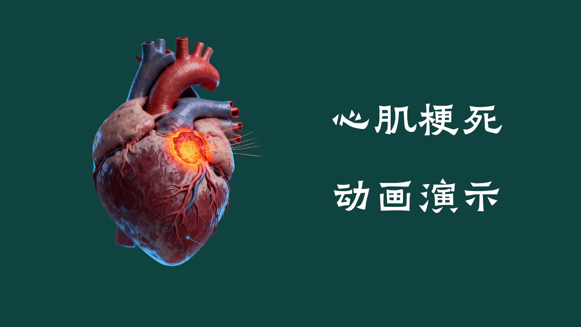 心肌梗死