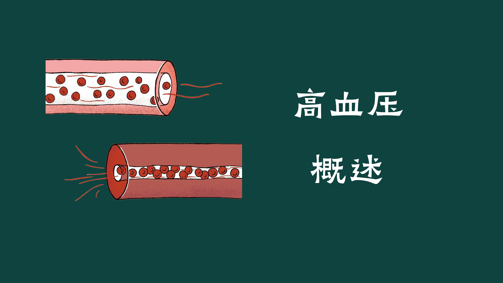 高血压