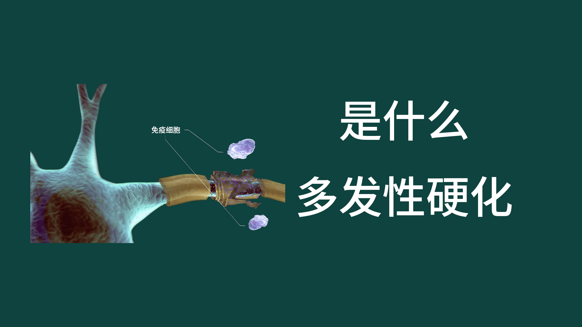 多发性硬化症