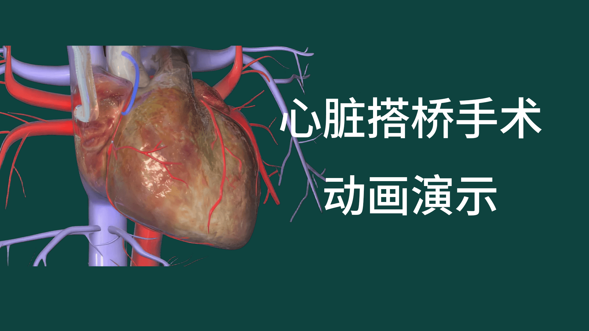 心脏搭桥手术