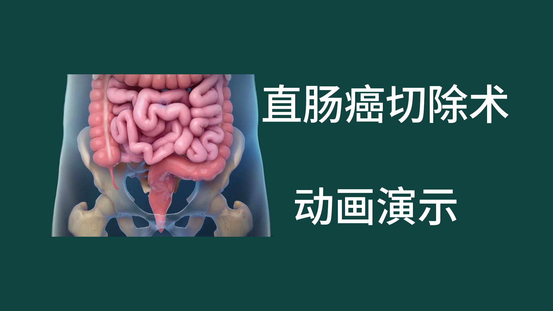 直肠癌切除术