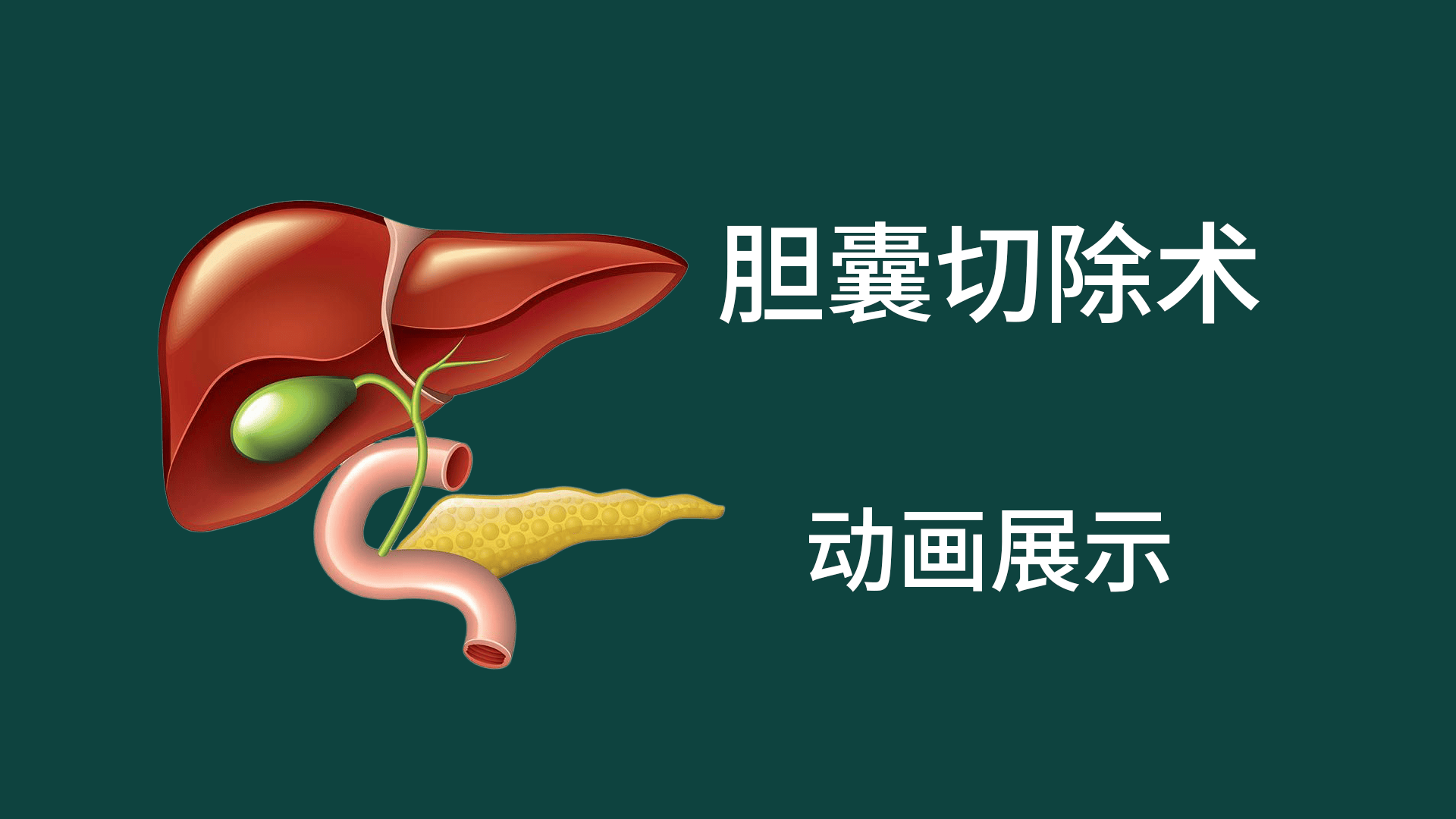 胆囊切除术